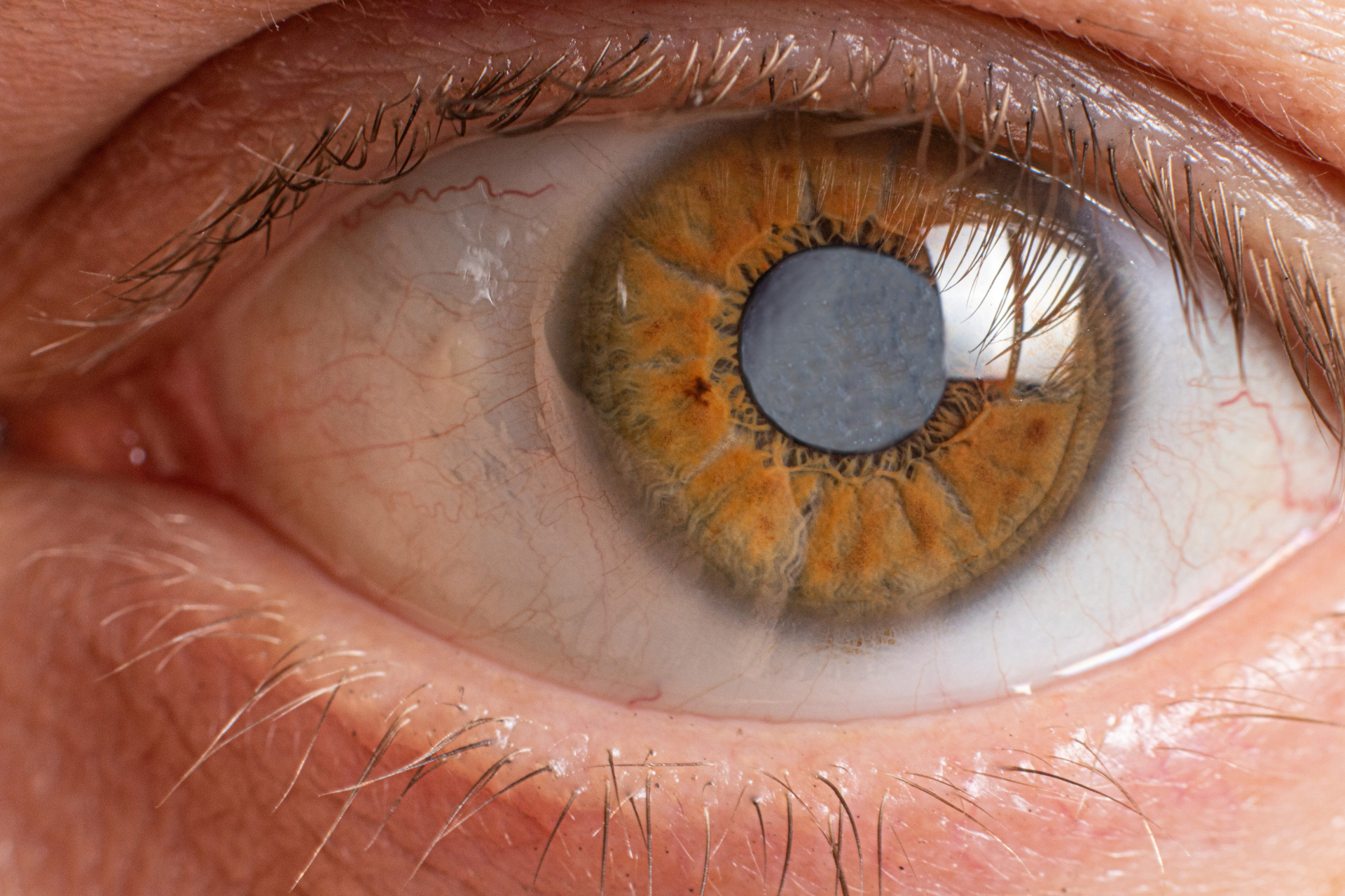Cataract Vision | Cataract Eye Surgery in Yelahanka | Krishna Nethralaya