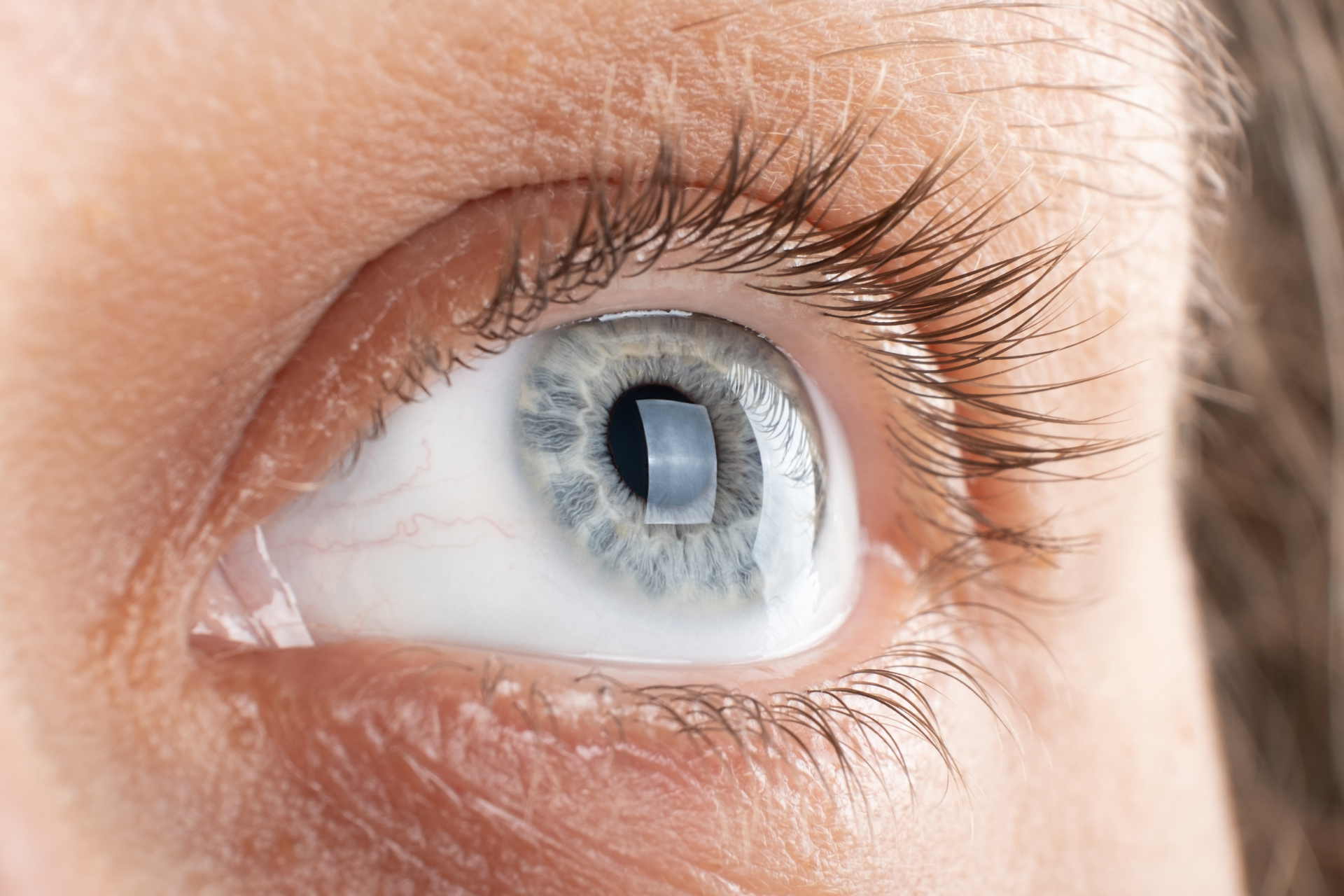 Prevent Blindness | Corneal Surgery in Yelahanka | Krishna Nethralaya